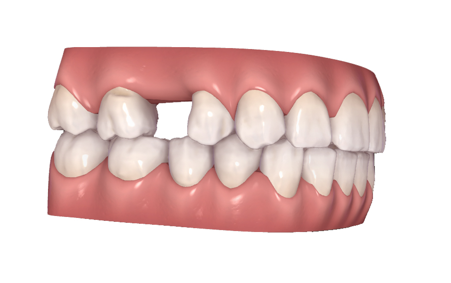 Missing_Tooth